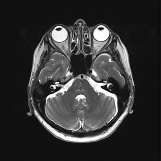 File:Anaplastic astrocytoma (Radiopaedia 86943-103160 Axial T2 12).png