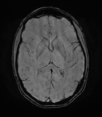 File:Anaplastic astrocytoma IDH mutant (Radiopaedia 50046-55341 Axial SWI 47).png