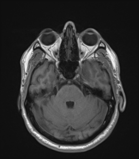 Anaplastic astrocytoma IDH wild-type (Radiopaedia 49984-55273 Axial T1 18).png