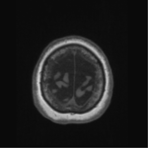 File:Anaplastic astrocytoma IDH wild-type (pseudoprogression) (Radiopaedia 42209-45276 Axial T1 136).png