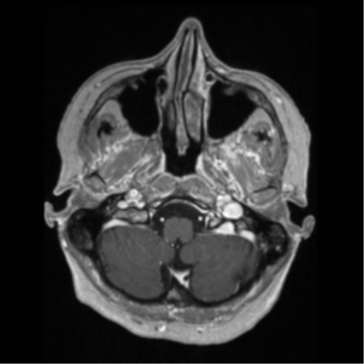 File:Anaplastic astrocytoma IDH wild-type (pseudoprogression) (Radiopaedia 42209-45276 Axial T1 C+ 27).png