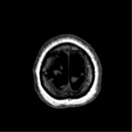 Anaplastic astrocytoma IDH wild-type (pseudoprogression) (Radiopaedia 42209-45277 Axial T1 126).png