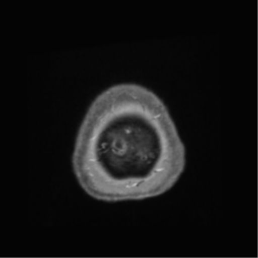 Anaplastic astrocytoma IDH wild-type (pseudoprogression) (Radiopaedia 42209-45278 Axial T1 C+ 150).png