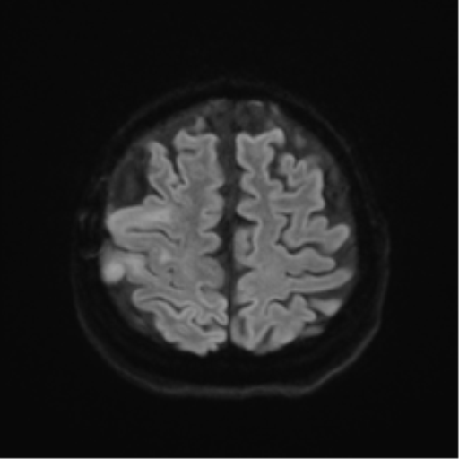 Anaplastic astrocytoma IDH wild-type (pseudoprogression) (Radiopaedia 42209-45279 Axial DWI 48).png