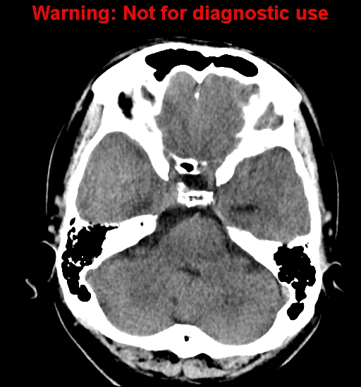 File:Anaplastic ganglioglioma (Radiopaedia 44921-48815 Axial non-contrast 7).jpg