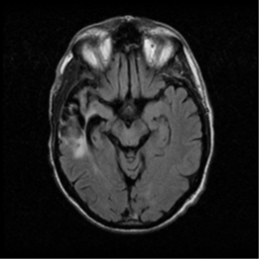 File:Anaplastic meningioma with recurrence (Radiopaedia 34452-35789 Axial FLAIR 10).png