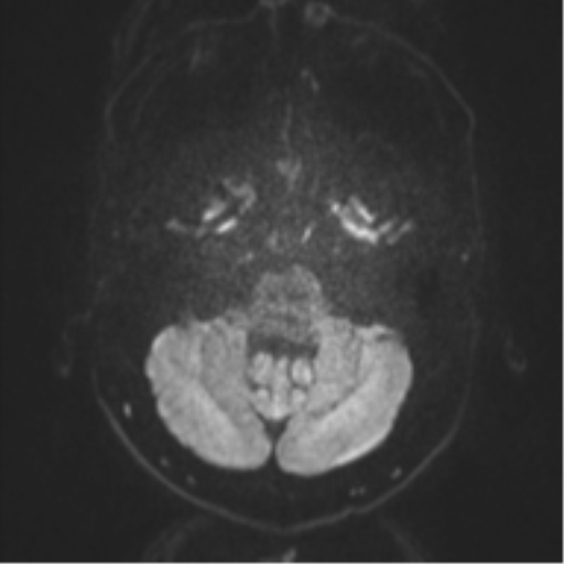 Anaplastic oligodendroglioma (Radiopaedia 37667-39563 Axial DWI 65).png