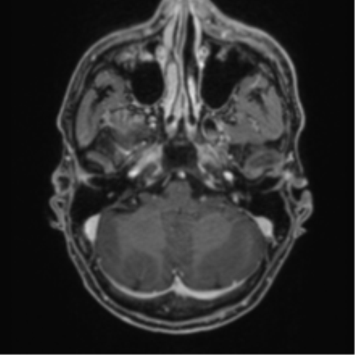 Anaplastic oligodendroglioma with skull fracture (Radiopaedia 74831-85845 Axial T1 C+ fat sat 9).png