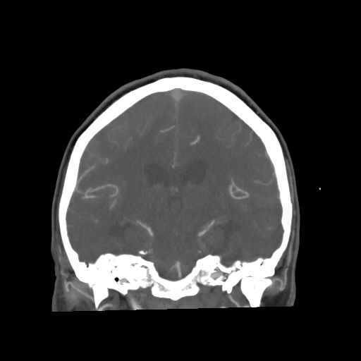 Aneursym related subarachnoid hemorrhage with hydrocephalus (Radiopaedia 45105-49084 B 45).jpg