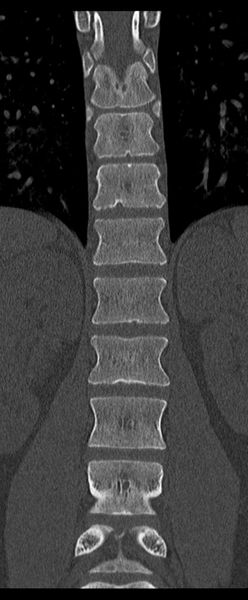 Aneurysmal bone cyst T11 (Radiopaedia 29294-29721 Coronal bone window 31).jpg