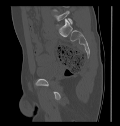Aneurysmal bone cyst of ischium (Radiopaedia 25957-26094 Sagittal bone window 32).png