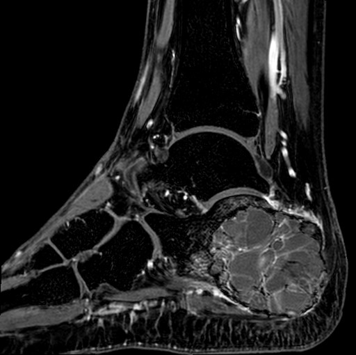 File:Aneurysmal bone cyst of the calcaneus (Radiopaedia 60669-68420 F 24).jpg
