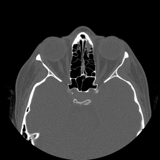 Aneurysmal bone cyst of the mandible (Radiopaedia 43280-46823 Axial bone window 175).jpg