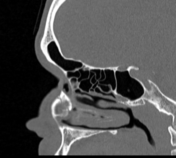 Angular epidermoid cyst (Radiopaedia 46908-51439 Sagittal bone window 32).png