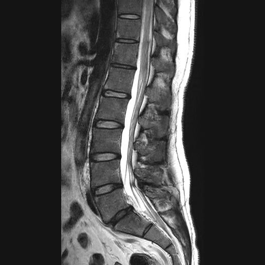 File:Ankylosing spondylitis with zygapophyseal arthritis (Radiopaedia 38433-40516 Sagittal T2 5).jpg
