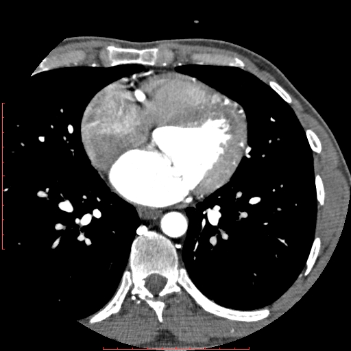 Anomalous left coronary artery from the pulmonary artery (ALCAPA) (Radiopaedia 70148-80181 A 187).jpg