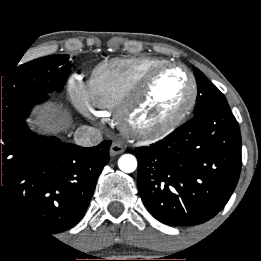 Anomalous left coronary artery from the pulmonary artery (ALCAPA) (Radiopaedia 70148-80181 A 303).jpg