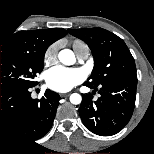 File:Anomalous left coronary artery from the pulmonary artery (ALCAPA) (Radiopaedia 70148-80181 A 95).jpg