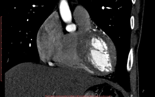 Anomalous left coronary artery from the pulmonary artery (ALCAPA) (Radiopaedia 70148-80181 B 98).jpg