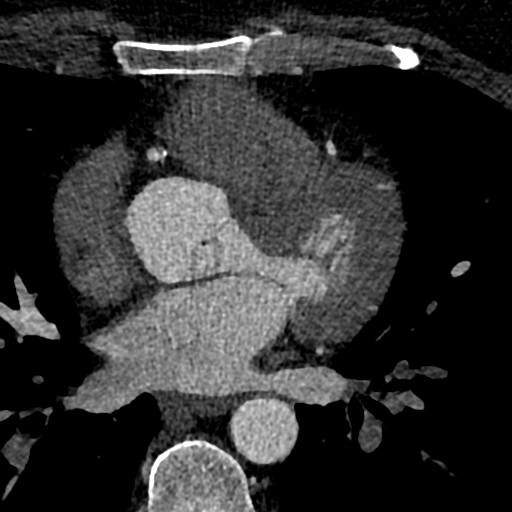 File:Anomalous origin of the left coronary artery with malignant course (Radiopaedia 77842-90126 C 91).jpeg