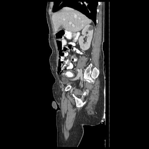 File:Anorectal carcinoma (Radiopaedia 44413-48064 C 32).jpg