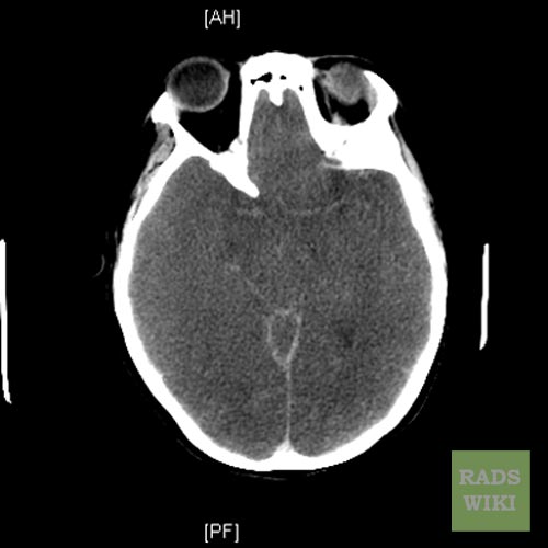 File:Anoxic brain injury (Radiopaedia 11191-11556 B 1).jpg