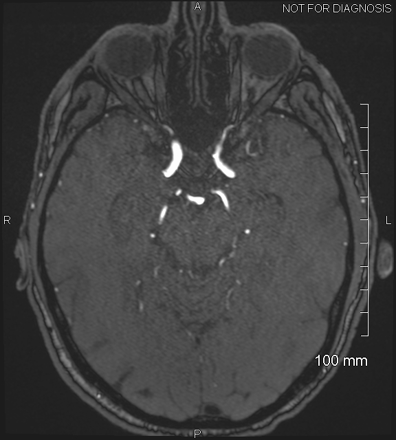 Anterior cerebral artery aneurysm (Radiopaedia 80683-94127 Axial MRA 92).jpg