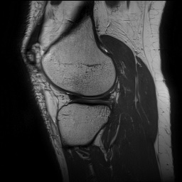 Anterior cruciate ligament rupture and posteromedial corner injury (Radiopaedia 67338-76723 Sagittal PD 123).jpg