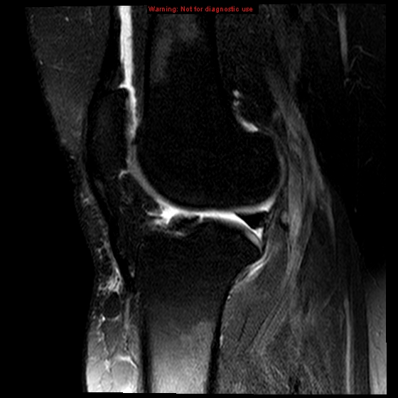 File:Anterior cruciate ligament tear (Radiopaedia 12329-12612 E 9).jpg
