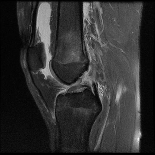 File:Anterior cruciate ligament tear (Radiopaedia 61500-69462 Sagittal PD fat sat 10).jpg