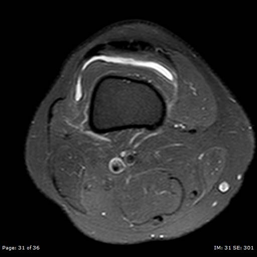 File:Anterior cruciate ligament tear (Radiopaedia 70783-80964 Axial PD fat sat 31).jpg