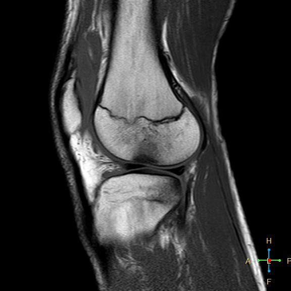 File:Anterior cruciate ligament tear - complete (Radiopaedia 24907-25170 Sagittal T1 4).jpg
