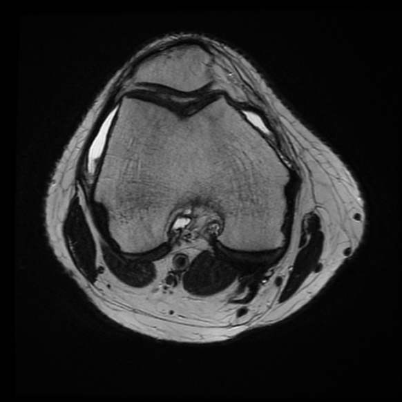 File:Anterior cruciate ligament tear with posteromedial corner injury, bucket-handle meniscal tear and chondral delamination (Radiopaedia 75501-86744 Axial T2 16).jpg
