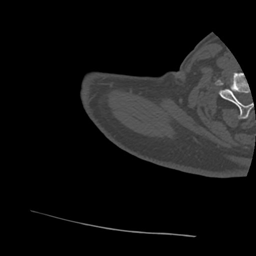 Anterior glenohumeral dislocation with Hill-Sachs lesion (Radiopaedia 62877-71249 Axial bone window 1).jpg