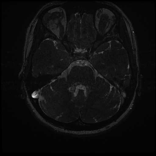 Anterior inferior cerebellar artery vascular loop - type II (Radiopaedia 70991-81209 Axial 3D FIESTA 12).jpg