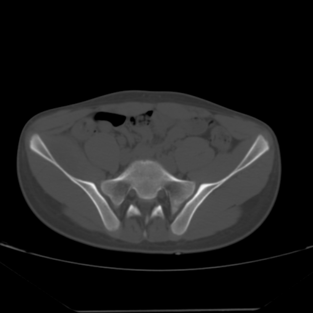 Anterior inferior iliac spine avulsion fracture (Radiopaedia 49469-54627 Axial bone window 10).jpg
