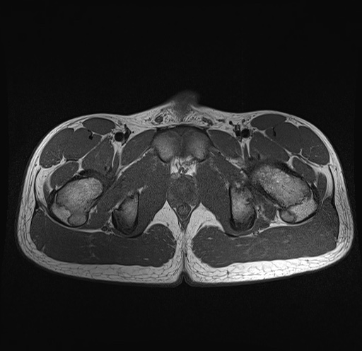 File:Anterior inferior iliac spine avulsion fracture (Radiopaedia 81312-95000 Axial T1 9).jpg