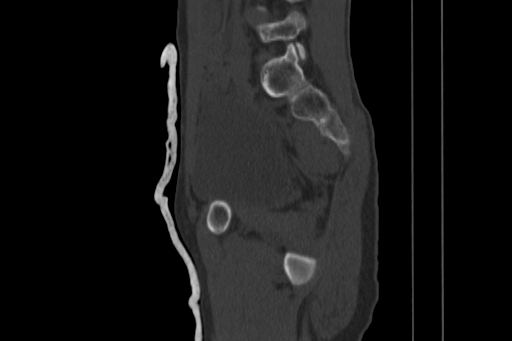 Anterior inferior iliac spine avulsion injury (Radiopaedia 88666-105376 Sagittal bone window 40).jpg