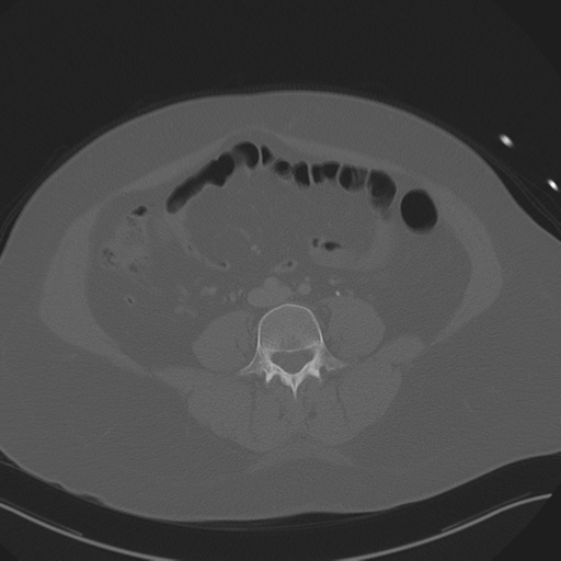 Anterior superior iliac spine avulsion fracture (Radiopaedia 44541-48244 Axial bone window 61).png