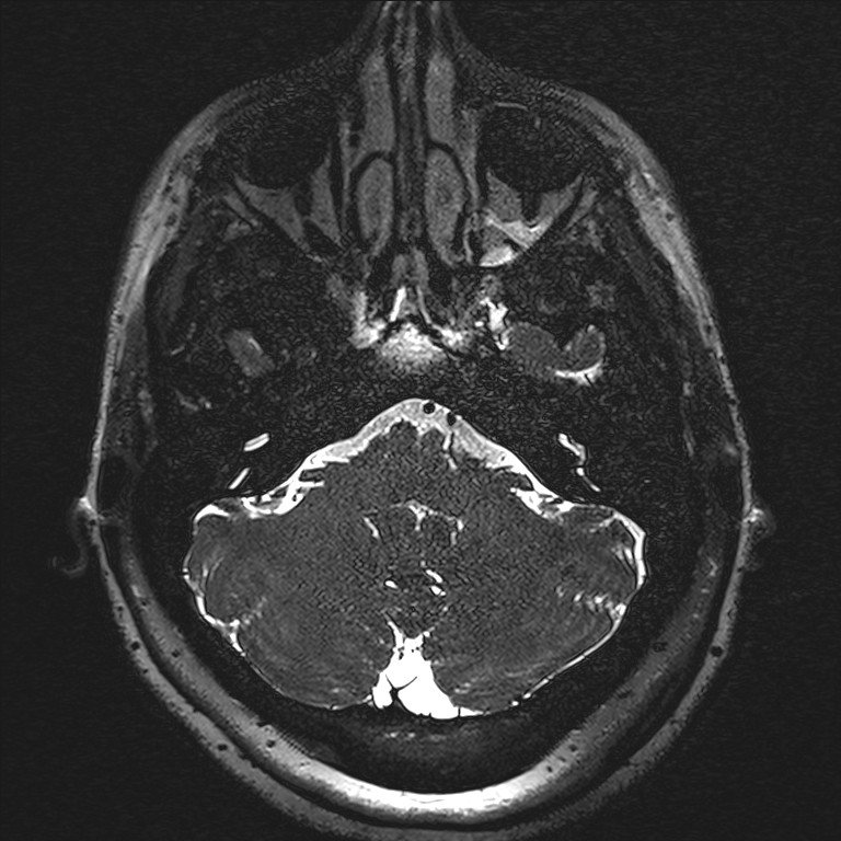 Anterior temporal encephalocele (Radiopaedia 82624-96808 Axial T2 high res 1).jpg
