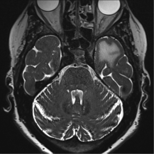 Anterior temporal pole cysts (Radiopaedia 46629-51102 Axial T2 50).png