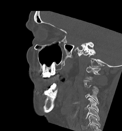 Anterior temporomandibular joint dislocation (Radiopaedia 59430-66784 B 20).jpg