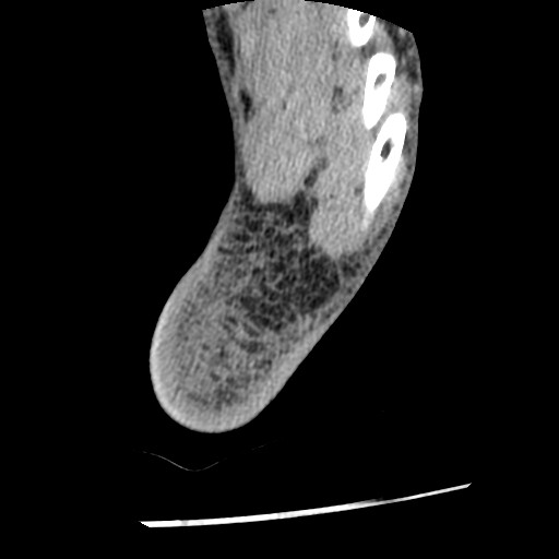 Anterior tibial artery false aneurysm (Radiopaedia 88984-105809 A 247).jpg