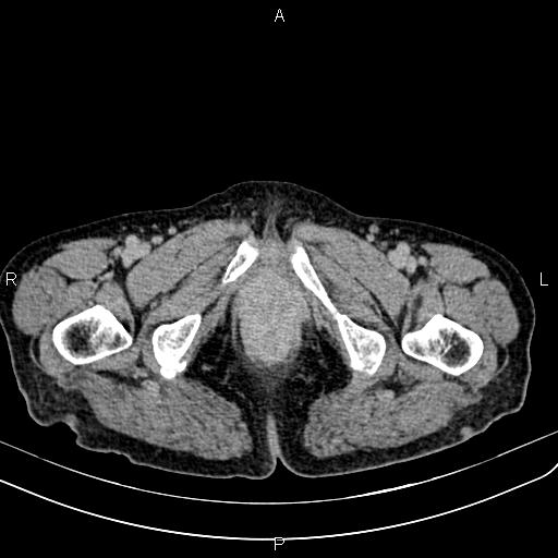 File:Aortic aneurysm and Lemmel syndrome (Radiopaedia 86499-102554 Axial C+ delayed 85).jpg