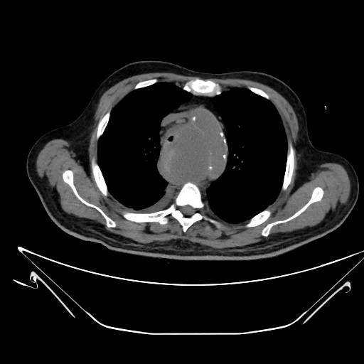 Aortic arch aneurysm (Radiopaedia 84109-99365 Axial non-contrast 92).jpg