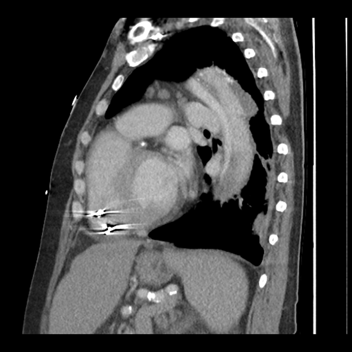 Aortic arch graft infection (FDG PET-CT) (Radiopaedia 71975-82437 C 45).jpg