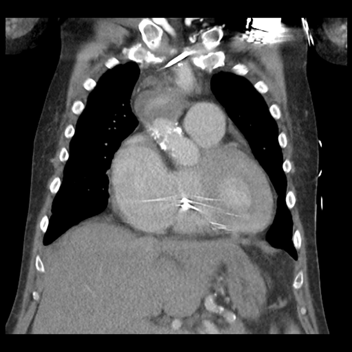 Aortic arch graft infection (FDG PET-CT) (Radiopaedia 71975-82437 Coronal 22).jpg