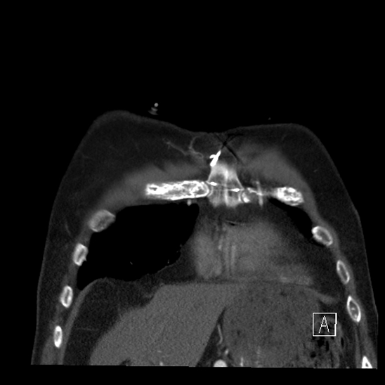 File:Aortic dissection (CTPA) (Radiopaedia 75506-86750 B 9).jpg