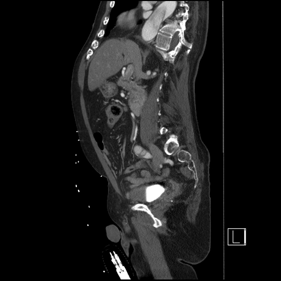 Aortic dissection (CTPA) (Radiopaedia 75506-86750 G 45).jpg