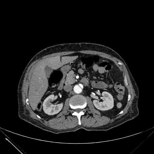 Aortic dissection (Radiopaedia 27466-27665 C+ arterial phase 346).jpg